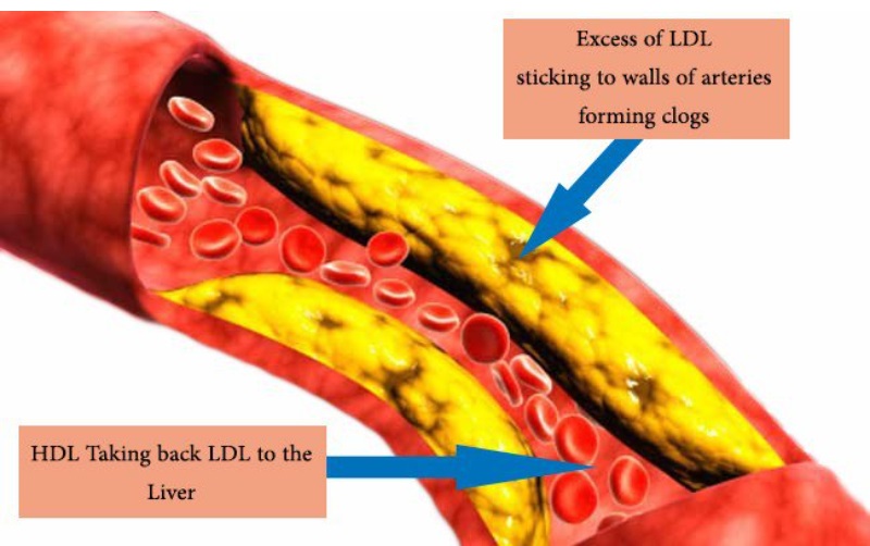 LDL cholesterol là gì