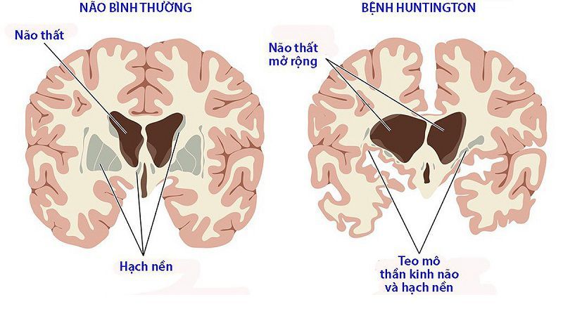 Sự khác bệnh giữa não người thường và não người bệnh Hungtington