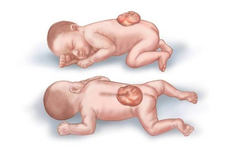 Dị tật ống thần kinh