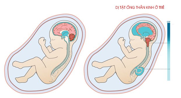 Các loại dị tật ống thần kinh thường gặp ở thai nhi