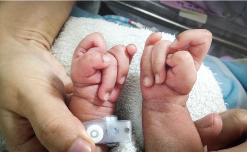 Trẻ bị hội chứng Edwards các ngón tay thường chồng chéo một cách bất thường