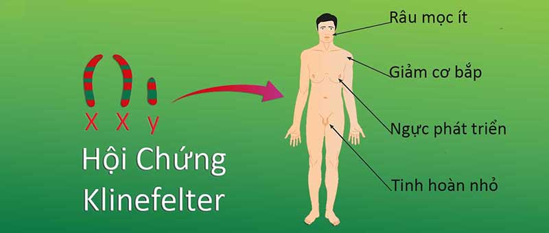 Hội chứng Klinefelter là gì?