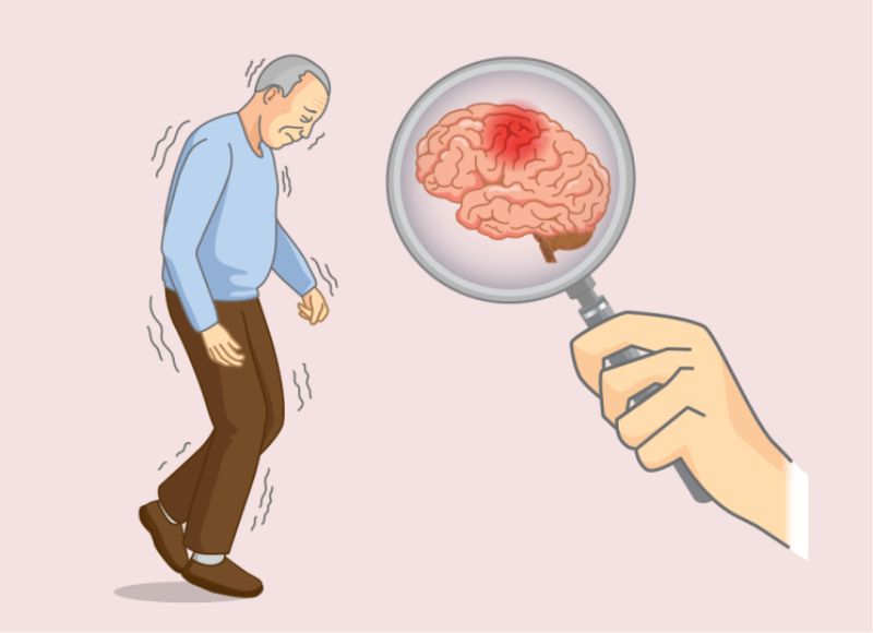 Alzheimer là một trong những nguyên nhân gây ra hội chứng sa sút tâm thần 