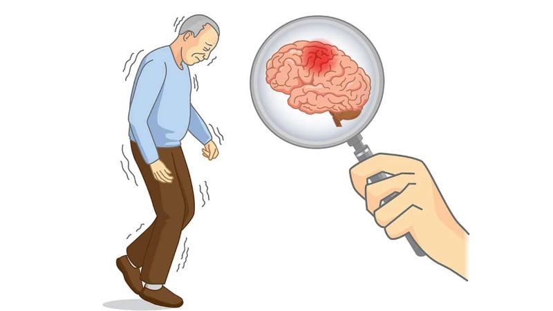 Rối loạn Parkinson cũng là một trong những triệu chứng của căn bệnh này 