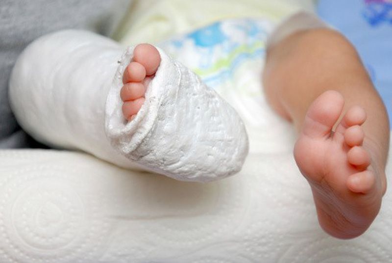 Tật đi nhón chân ở trẻ em có thể được điều trị dứt điểm nếu bạn phát hiện sớm 